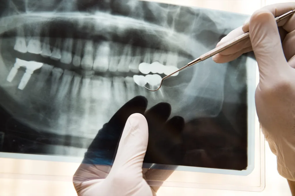Wisdom Teeth Extraction In Hicksville